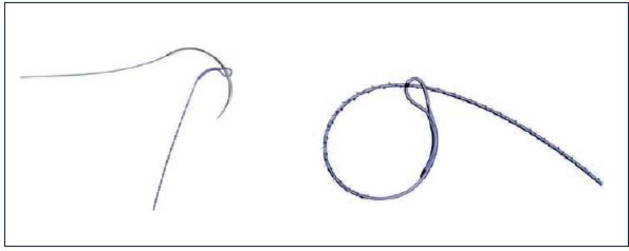 Protažení jehly koncovým okem
Převzato: Greenberg JA. The use of barbed sutures in obstetrics and gynecology. Rev Obstet Gynecol 2010; 3(3): 82–91.
Fig. 2. The stretching a needle the eye at the end of a stitch
Source: Greenberg JA. The use of barbed sutures in obstetrics and gynecology. Rev Obstet Gynecol 2010; 3(3): 82–91.