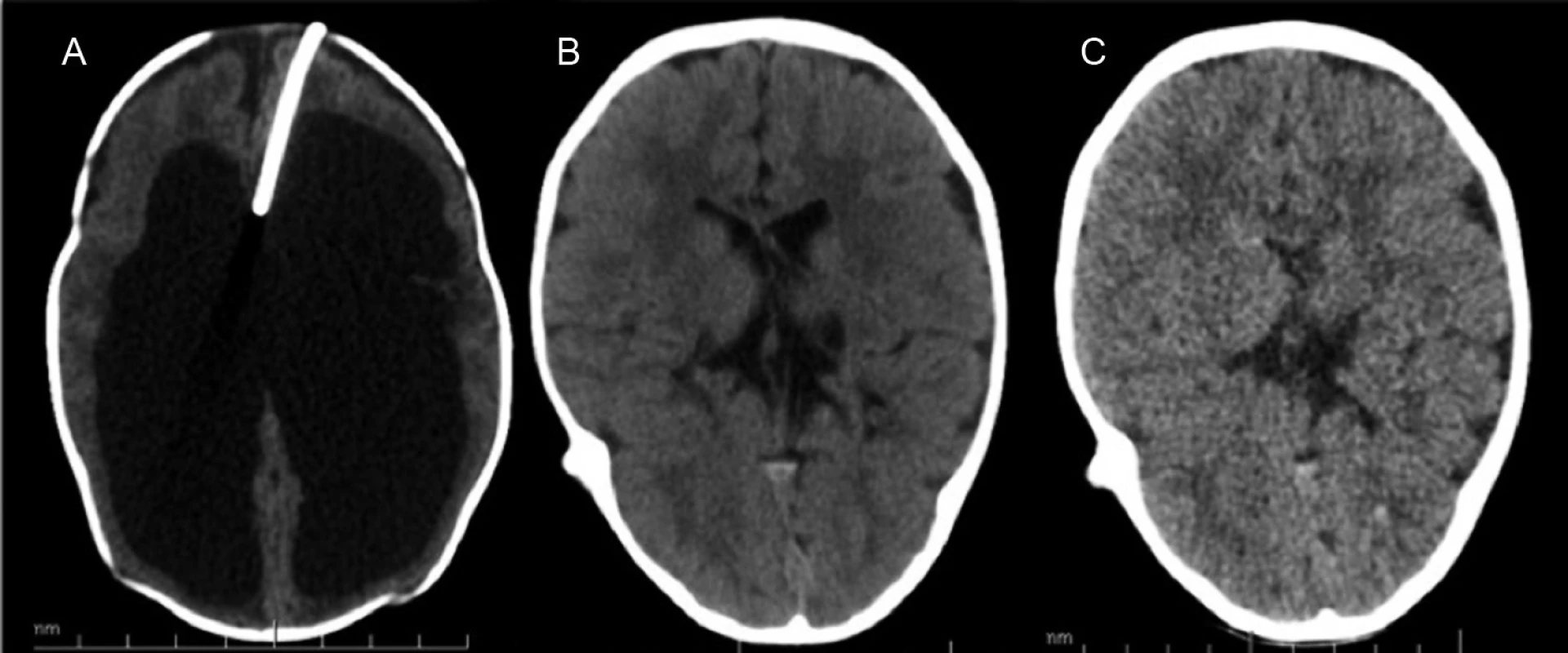 Hydrocefalus riešený rezervoárom a ventrikuloperitoneálnym shuntom.
Typické zmenšenie objemu komôr.
A – CT mozgu pred zavedením VPS s implantovaným komorovým rezervoárom, B – CT mozgu 1 rok po implantácii, C – CT mozgu 2 roky po implantácii VPS.
Fig. 1. Hydrocephalus cured with a ventriculoperitoneal shunt. A typical decrease of the chamber volume. 
A – Brain CT before the introduction of CPS ith implanted ventricular reservoir, B – brain CT one year after the implantation, C – brain CT two years of VPS implantation.