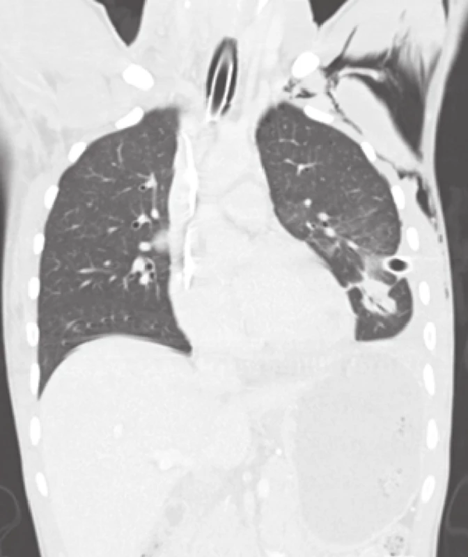 Obr. 1: Průstřel levé plíce, hrudní drén v levém hemitoraxu, podkožní emfyzém − koronální řez
Fig. 1: The bullet channel in the left lung, chest drain in the left hemithorax, subcutaneous emphysema − coronal section