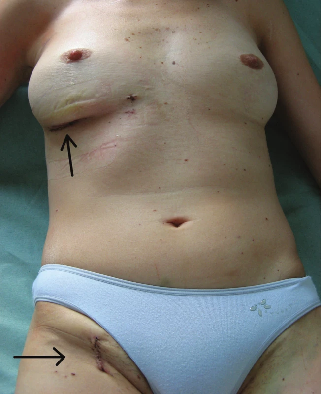 Výsledný kosmetický efekt
Minitorakotomie a rána v třísle.
Fig. 3: Postoperative aesthetic appearance 
Minithoracotomy and the wound in the groin.