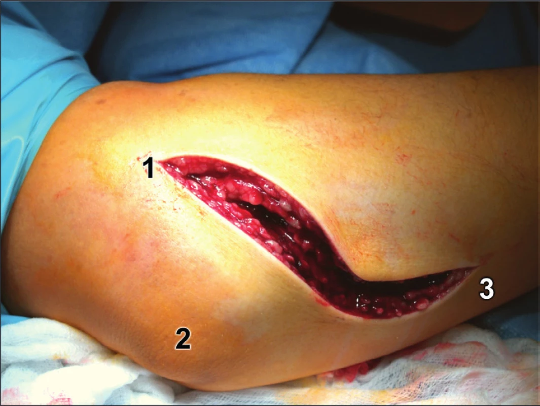 Rozšířený modifikovaný Kocherův přístup – kožní řez: 1 – epicondylus lateralis humeri, 
2 – olekranon, 3 – ulna.
Fig. 13: Extended modified Kocher approach – skin incision: 1 – lateral epicondyle of humerus, 
2 – olecranon, 3 – ulna.