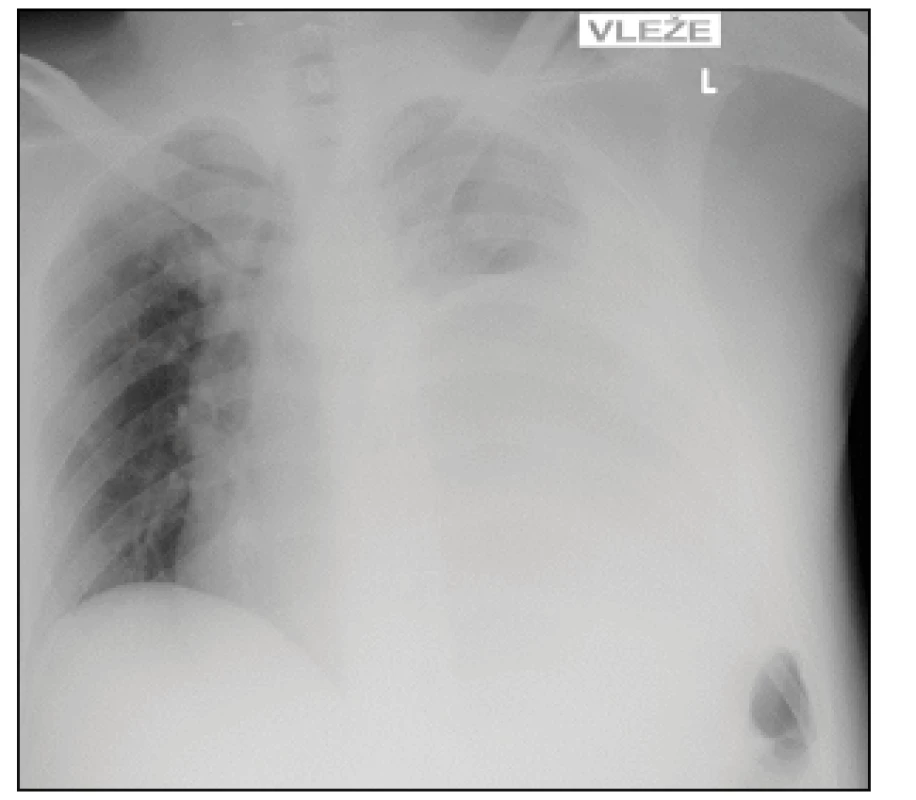 Nejasný nález na RTG hrudníku, zastření levého hemithoraxu, deviace trachey vpravo
