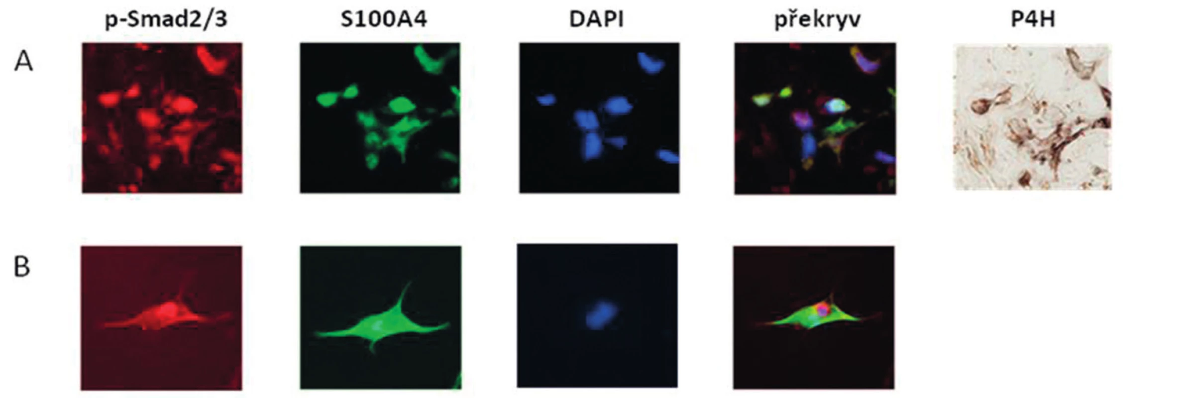 Kolokalizace exprese S100A4 a p-Smad2/3 v SSc kůži a v aktivovaných fibroblastech.
