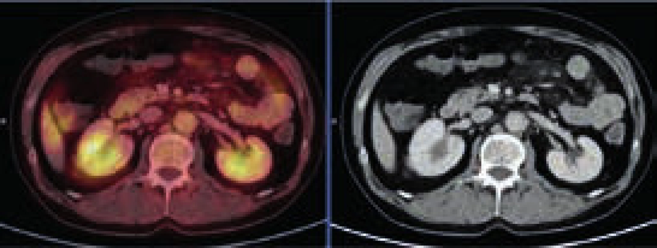 PET-CT zobrazení břicha