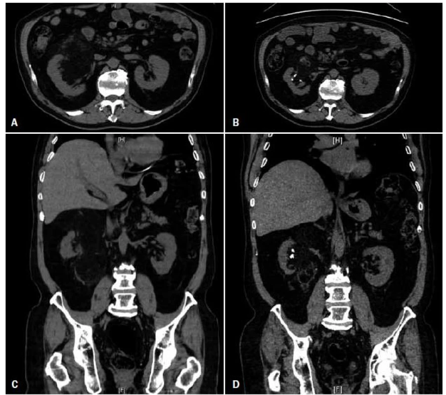 Druhý případ. CT vyšetření břicha 65letého pacienta demonstruje pravostranný renální angiomyolipom (AML) v (A) axiální a (B) koronální rovině. Rozměry léze: 9,5 × 9,4 × 15,5 cm. CT vyšetření tři roky po embolizaci (C a D) odhalilo zmenšení velikosti AML na 7,2 × 6,7 × 12,9 cm a přítomnost embolizačního materiálu v lézi, bez známek hydronefrózy či litiázy.