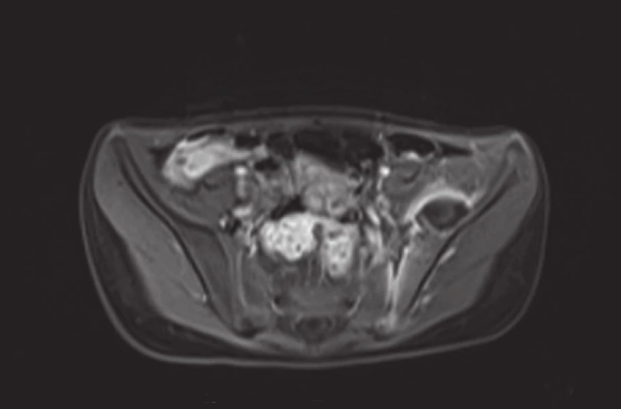 MRI pánve - absces mezi levou lopatou kosti kyčelní a musculus iliacus, sakroileitida vlevo
a) T2 TIRM transverzálně (sekvence s potlačením signálu tuku), tekutinové ložisko v pánvi vlevo, edém kosti, SI skloubení a musculus iliacus
b) DWI b800 transverzálně – hypersignální hladinka hnisu
c) ADC mapa transverzálně – v ložisku hyposignální hladinka hnisu
d) T2 sagitálně – ložisko s hladinkou, edém musculus iliacus
e) T1 VIBE transverzálně po kontrastní látce – prstenčité sycení stěny ložiska typické pro absces
f) T1 VIBE transverzálně po kontrastní látce – sycení okrajů ložiska a SI skloubení