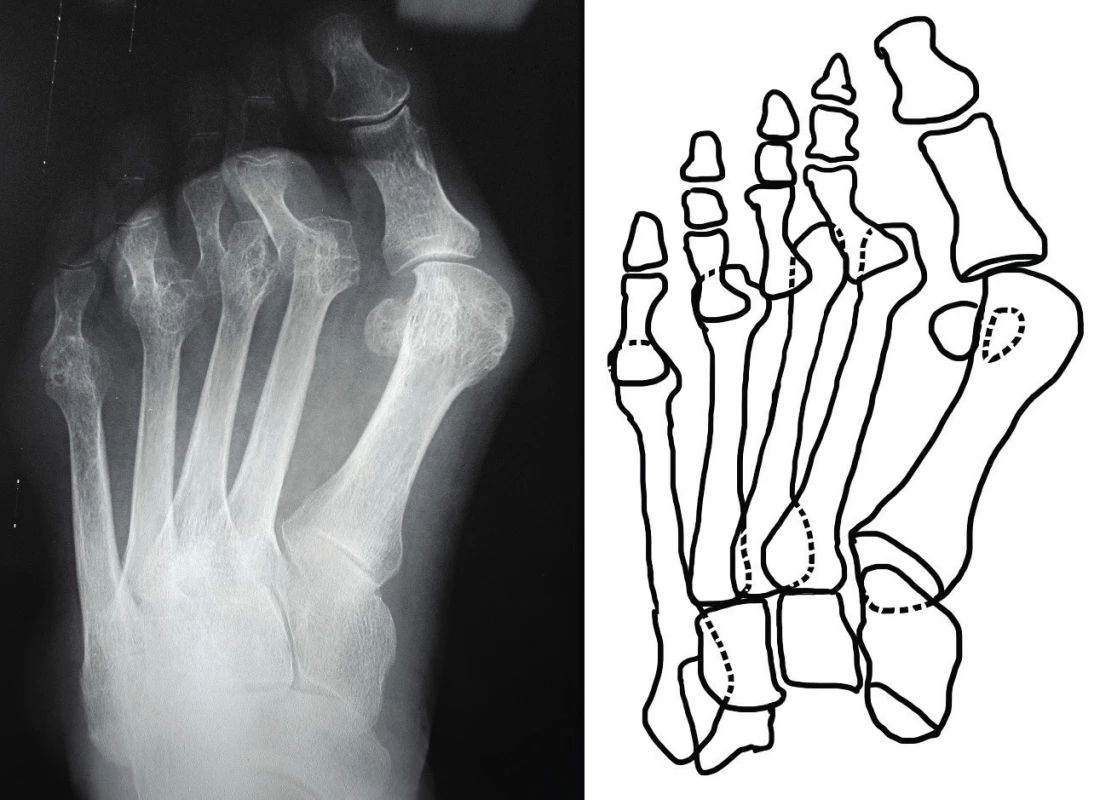 Předozadní rentgenový snímek přednoží s destrukcí hlaviček metatarzů a luxací II. až V. metatarzofalangeálního skloubení; patrná hallux valgus deformita palce nohy, varózní postavení I. metatarzu se zvětšením prvního intermetatarzálního úhlu.