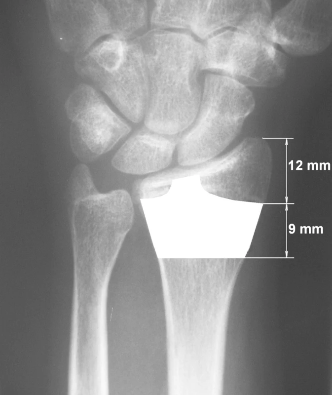 Indikační šíří hřebu jsou zlomeniny lokalizované ve zvýrazněné oblasti distálního rádia
Fig. 6. The nail indication areas include fractures located within the highlighted region of the distal radius