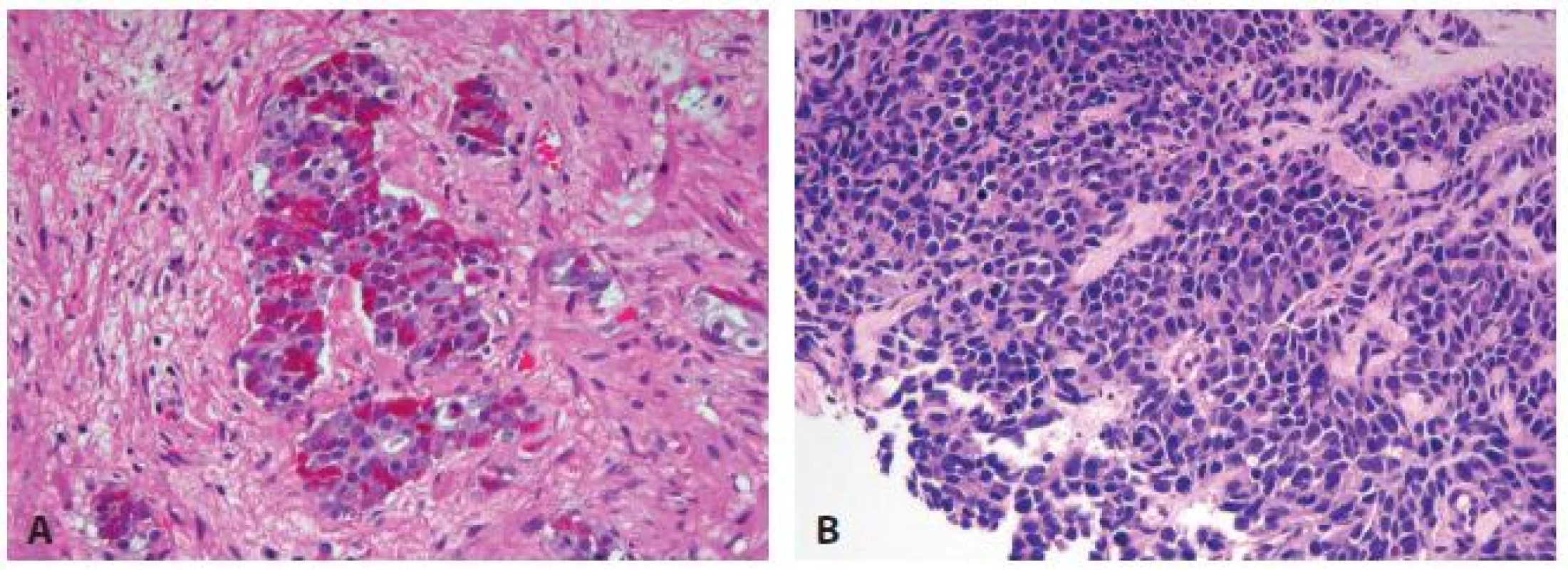 Prostate carcinoma with neuroendocrine differentiation. (A) Paneth cell-like NE differentiation. (B) Small cell carcinoma.