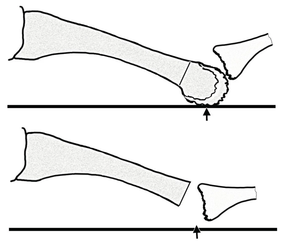 Boční pohled na druhý metatarz; schematické znázornění resekce hlavičky metatarzu; osteotomie se provádí z plantárního přístupu a odstraňuje se celá destruovaná hlavička; černá šipka – místo zátěže.