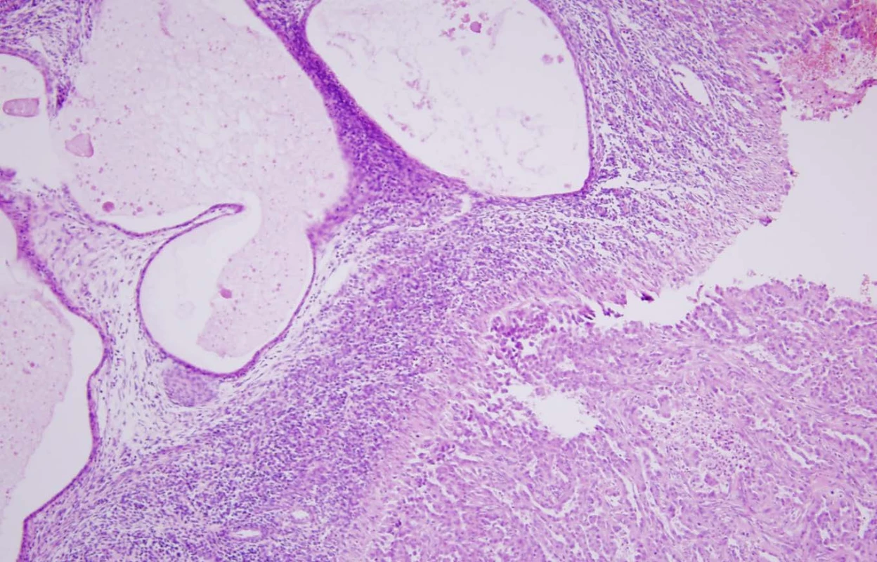 Histologické vyšetření preparátu tumoru ledviny: ložisko endometriózy s endometriálními žlázkami, zvětšení 100x
Fig. 4. Histological specimen of kidney tumor – focus of endometriosis with endometrial glands on the left part of the picture, ZOOM 100x