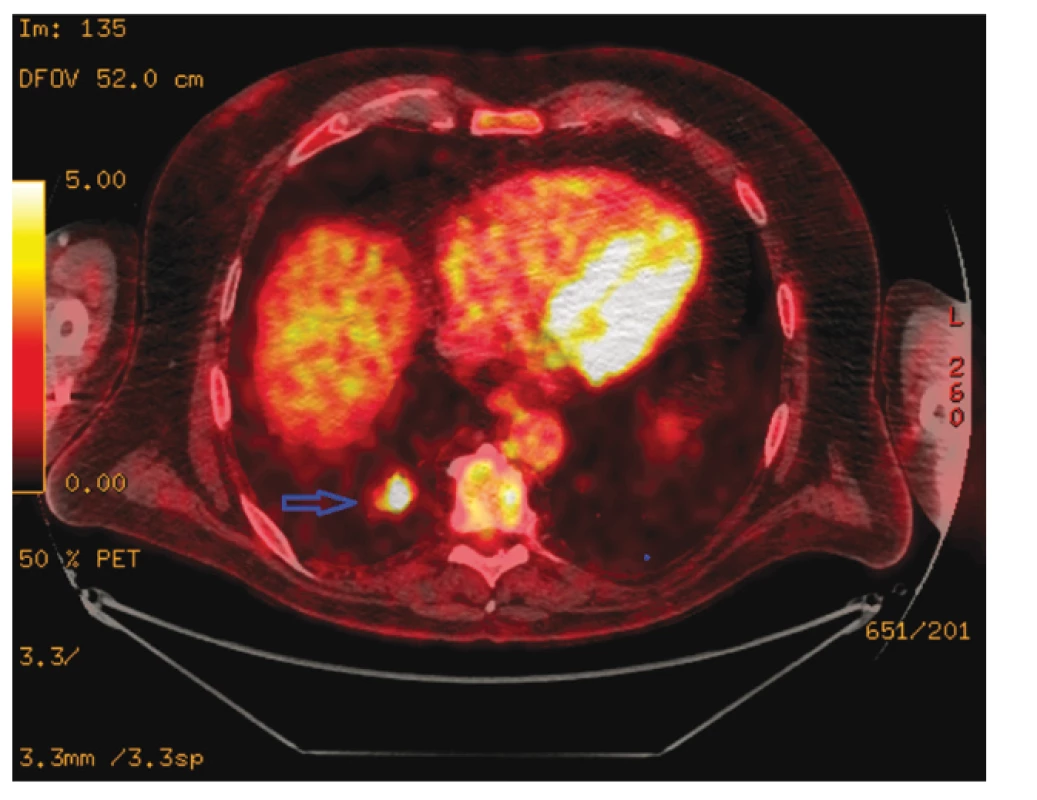 Plicní metastáza před terapií nivolumabem –
PET/CT (zdroj: Ústav nukleární medicíny VFN)