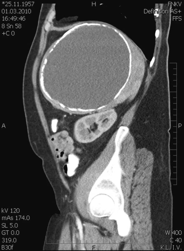 Poúrazová pseudocysta sleziny v CT scanu – sagitální řez
Fig. 3. Post-traumatic pseudocyst of the spleen on CT scan – saggital section