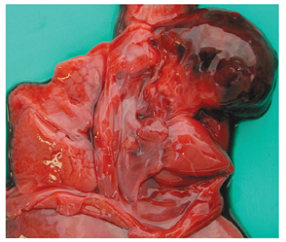Intrapericardial teratoma. The tumor is fixed by a fibrous stalk to the aortic stem, otherwise it moves freely. Slightly displaced and compressed heart and left lung.
