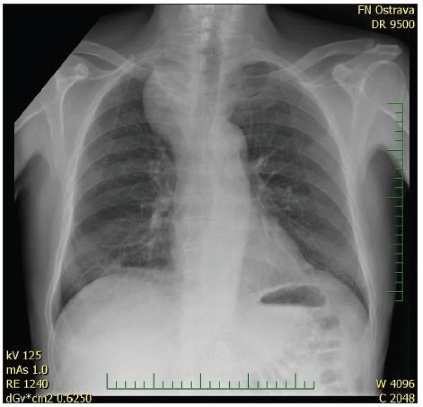RTG snímek 3 týdny po operaci, výrazná regrese nálezu
Pic. 3. X-ray 3 weeks after surgery, significant regression