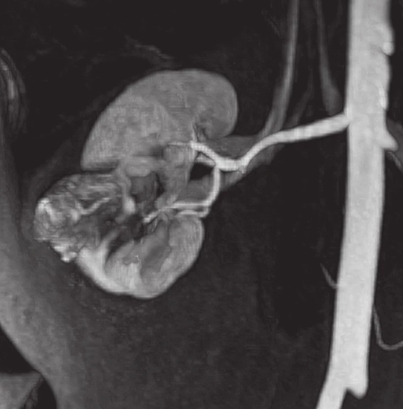 3T MRA pravé ledviny s tumorem v dolním pólu uloženým převážně intrarenálně, časné větvení renální tepny a zdvojená renální žíla
Fig. 3. 3T MRA of the right kidney with intrarenal tumour of the lower pole, early branching of the artery and duplex renal vein