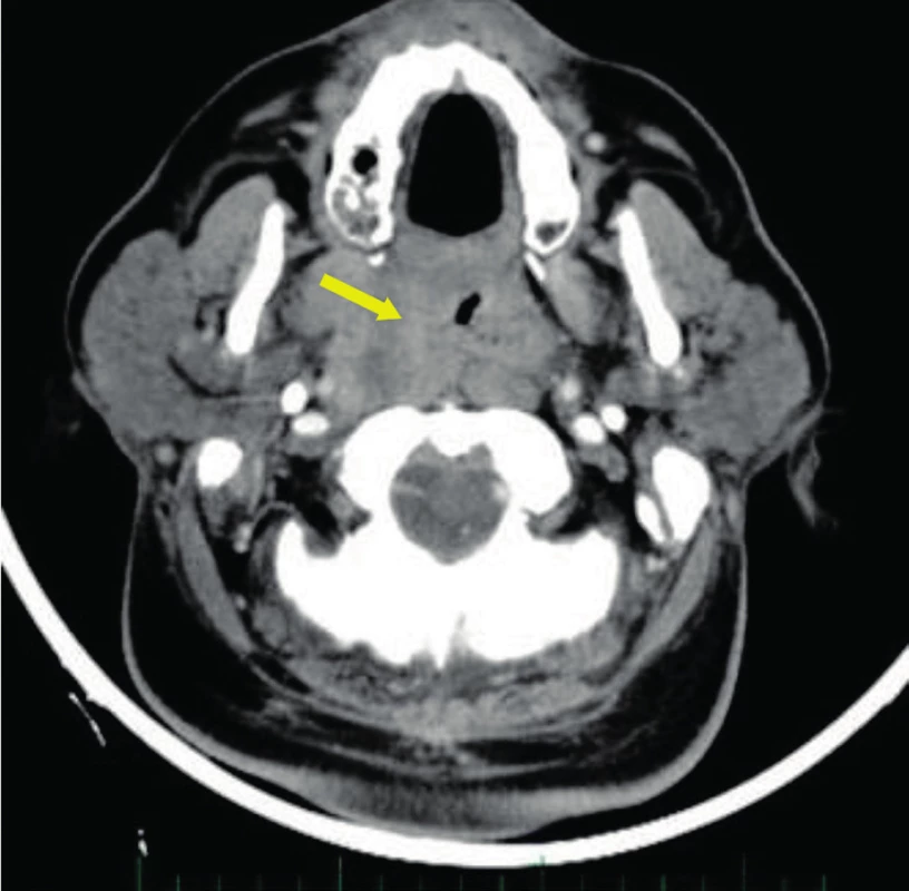 CT postkontrastní snímek - šipka ukazuje na karcinom tonzily stadia T4 postihující tvrdé patro a prevertebrální svaly.