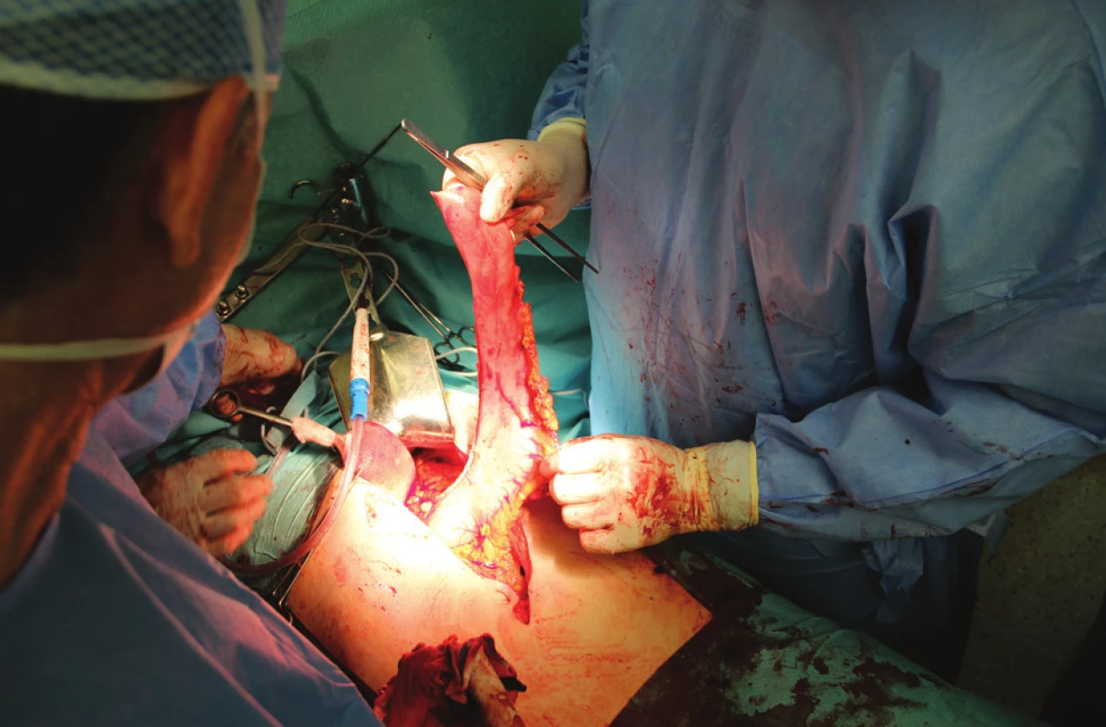 Operační nález: tubulizovaný žaludek s výživou cestou arteria gastroepiploica dextra připravený pro rekonstrukci na konci abdominální fáze výkonu