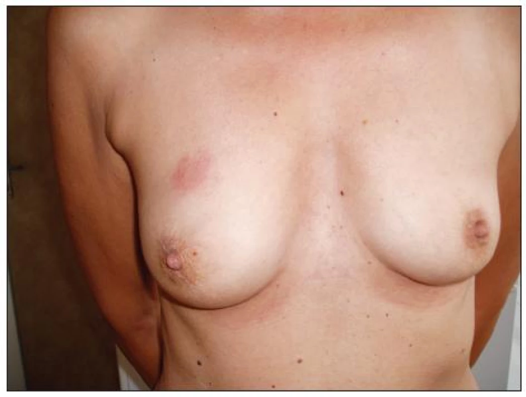 Nález na pravém prsu
Fig. 9. The right breast finding