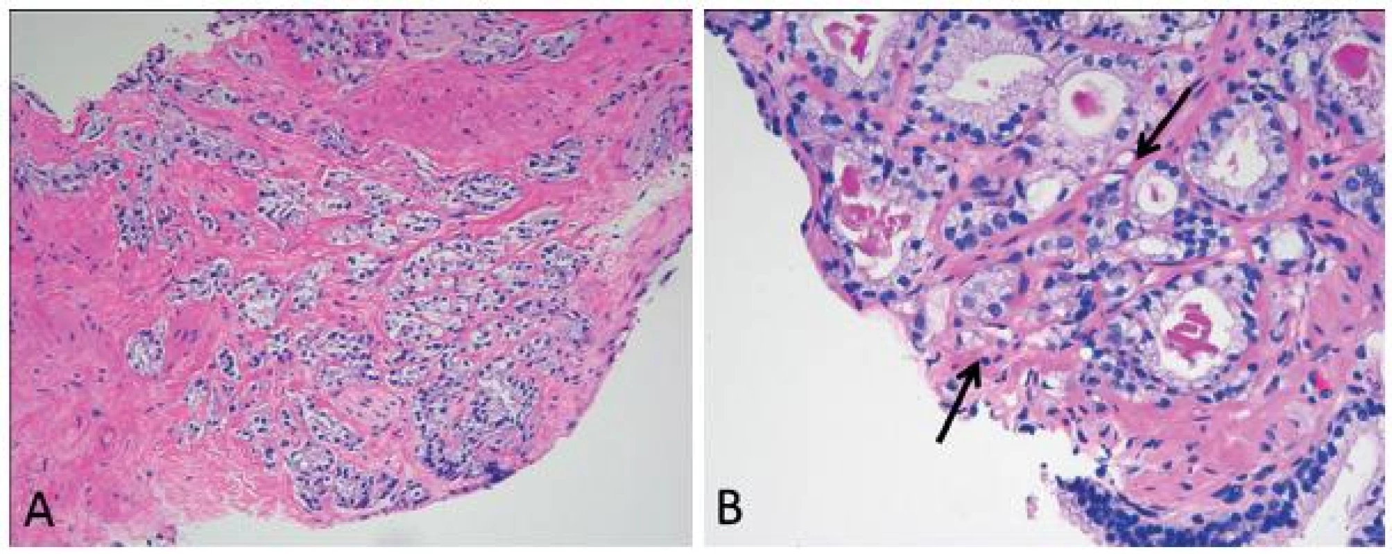 Grade 4 poorly formed glands (A) should be differentiated from small glands resulting from tangential sectioning (B, arrows). The latter typically encompasses only a few poorly formed glands that are adjacent to or intermingle with other well-formed small glands.