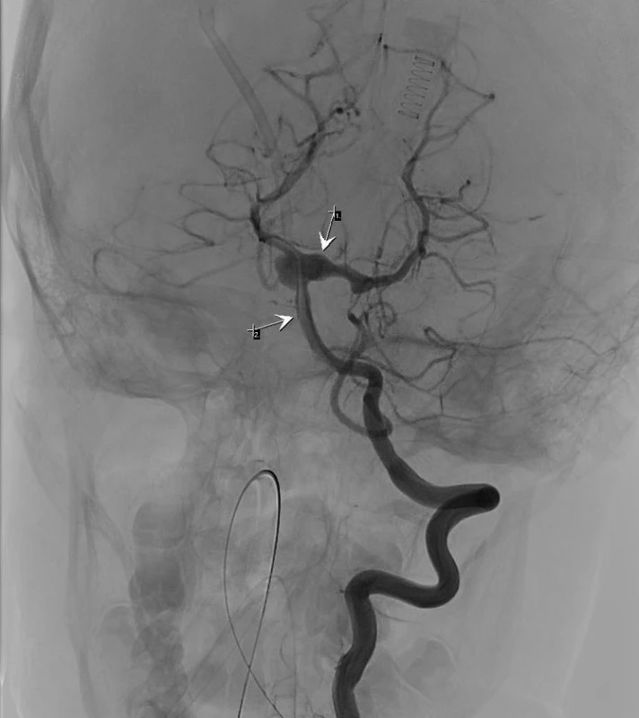 Angiografie, aneurysma a. basalis (2) přestupující na obě ACP (1)