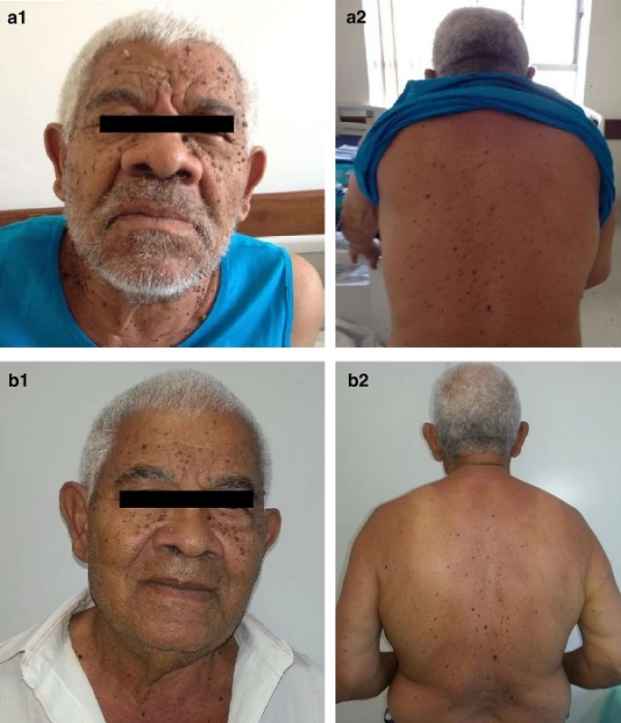 Sign of Leser-Trélat. Multiple lesions on the face (&lt;b&gt;a&lt;/b&gt;) and back of the patient (&lt;b&gt;b&lt;/b&gt;) compatible with seborrheic keratoses