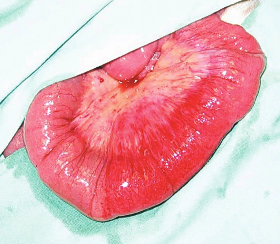 Kazuistika II – Sporně vitální úsek ilea
Fig. 5. Case report II – The segment of ileal bowel with uncertain vitality
