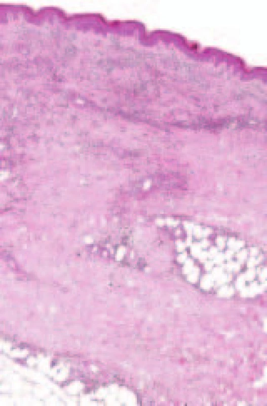 Přehledný histologický obraz zachycující leukocytoklastickou vaskulitidu postihující povrchový i hluboký cévní plexus (ve spodní části obrázku zasahuje zánět až k podkožnímu tuku). Barvení hematoxylin-eozin, objektiv PIApo 40krát.