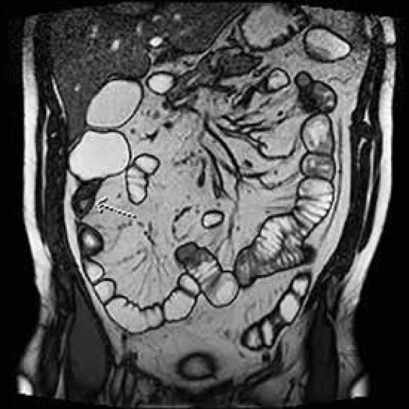 MR enterografie – st. p. IC resekci s stenózou anastomózy a neoTI s lehkou predilatací a klinickou manifestací pasážovacích obtíží