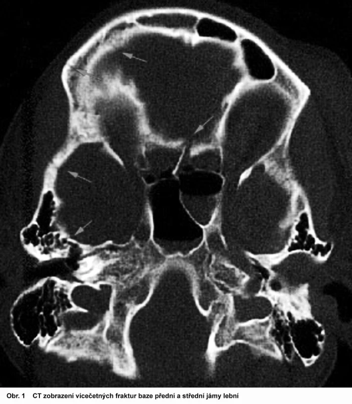CT zobrazení vícečetných fraktur baze přední a střední jámy lební