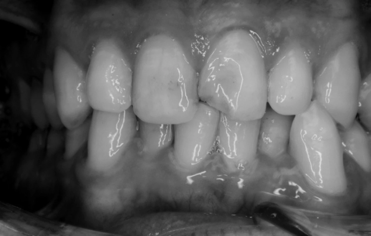 Nekomplikovaná fraktura zubu 21 u pacienta s mentální retardací středního stupně.