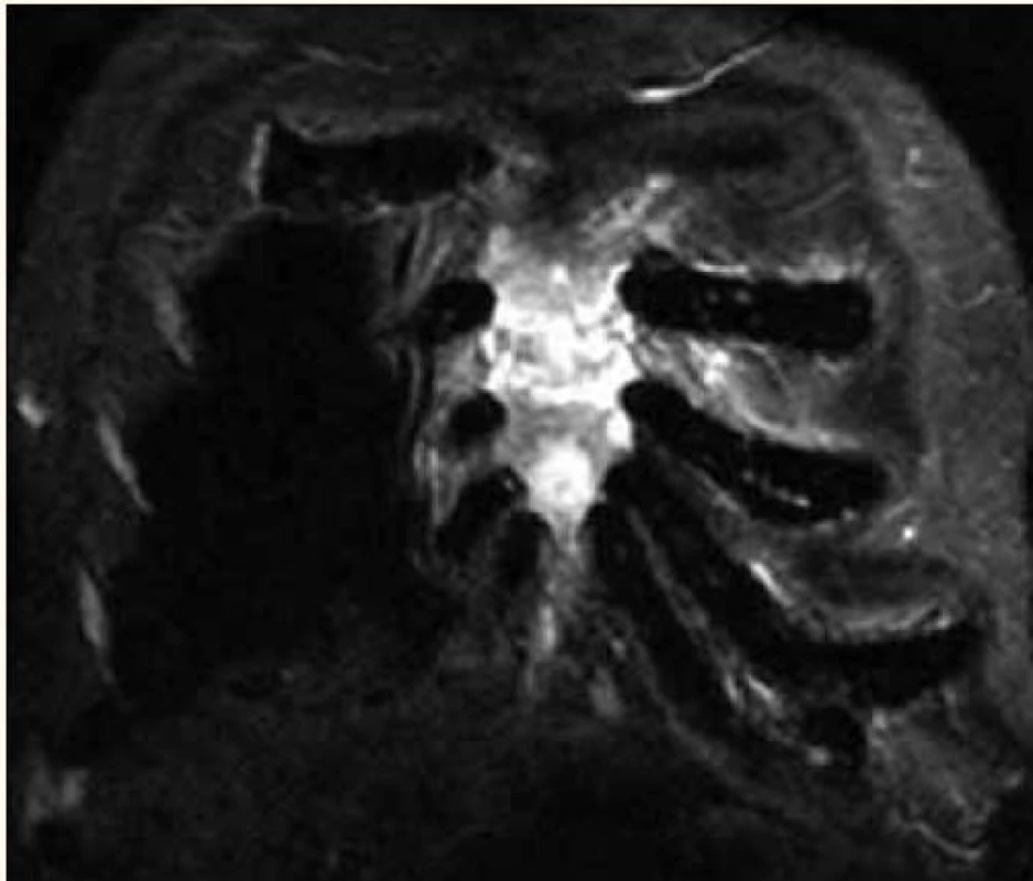Infiltrace sterna myelomem v MR obraze.