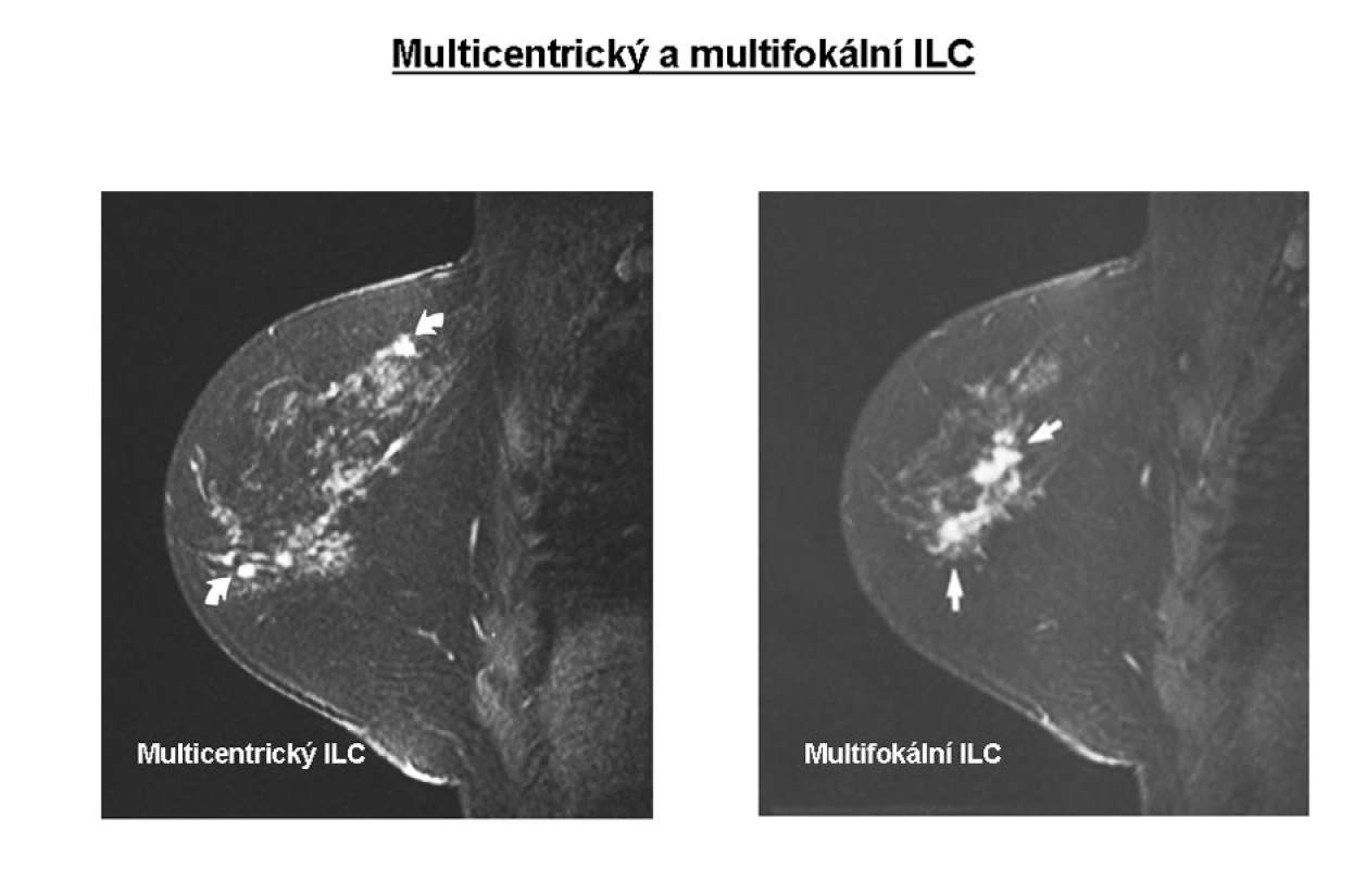 Snímek vlevo zobrazuje 2 ložiska karcinomu prsu v různých kvadrantech (multicentrický karcinom). Na pravém snímku vidíme 2 ložiska ve stejném kvadrantu (multifokální karcinom)
Pic. 2. The left view shows 2 foci of the breast carcinoma in two different quadrants (multicentric carcinoma). The right view depicts 2 foci in the same quadrant (multifocal carcinoma)