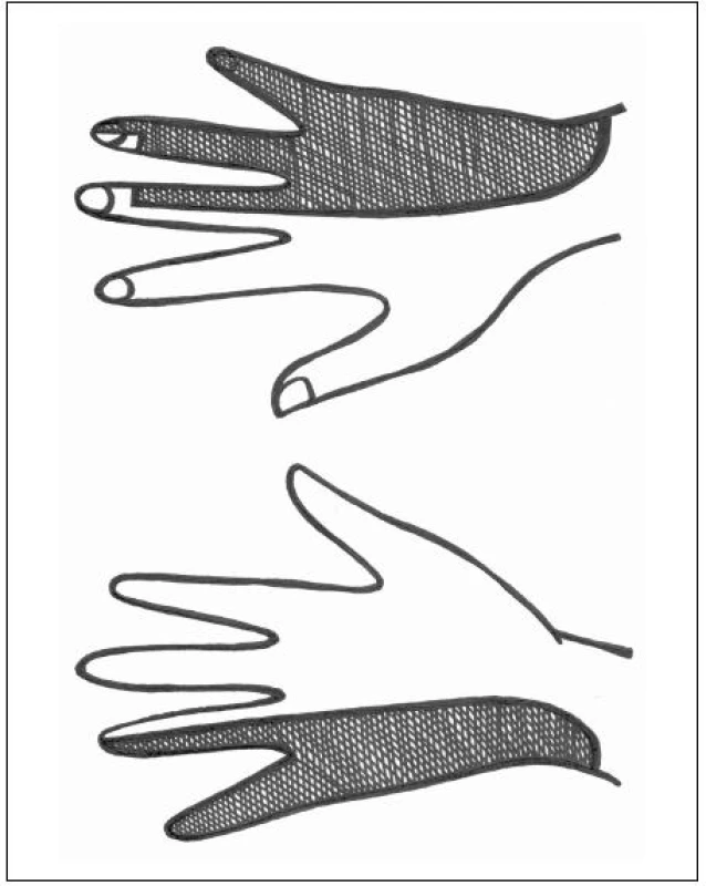 Senzitivní inervace n. ulnaris na dlani a dorzu ruky