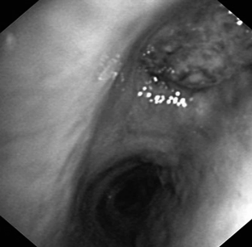 Tumor (epidermoidní karcinom) obturující lobární bronchus pro horní lalok vpravo jako příčina opakovaných hemoptýz