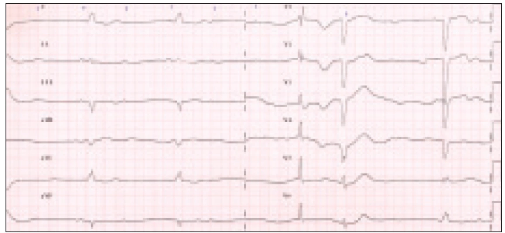 Vstupní EKG s patrnou atrioventrikulární blokádou III. st. se širokými QRS komplexy a bradykardií 20–32/min.