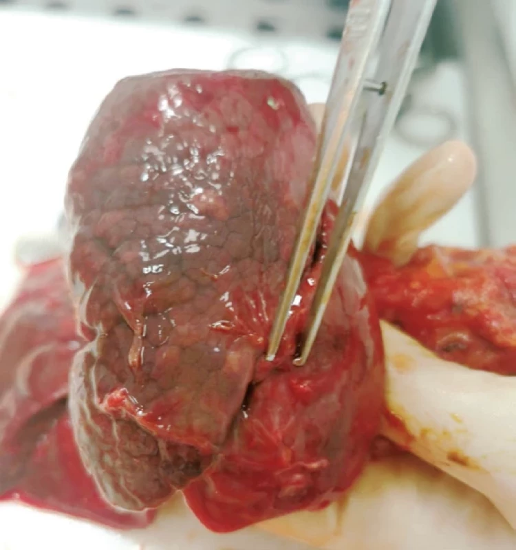Pleurální srůsty po pleurodéze u pacienta z kazuistiky 2 (pitevní nález)