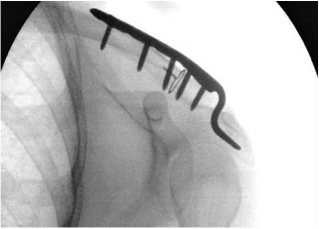 Zlomenina klíčku Neer IIb po stabilizaci háčkovou dlahou
Fig. 6: Neer IIb clavicle fracture, result after stabilisation using a hook plate