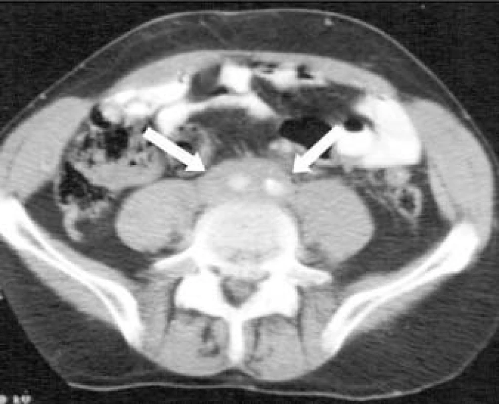 Abdominální CT-sken pacienta s retroperitoneální fibrózou; na skenu je patrná hustá masa pokrývající abdominální aortu a dolní dutou žílu (šipky).