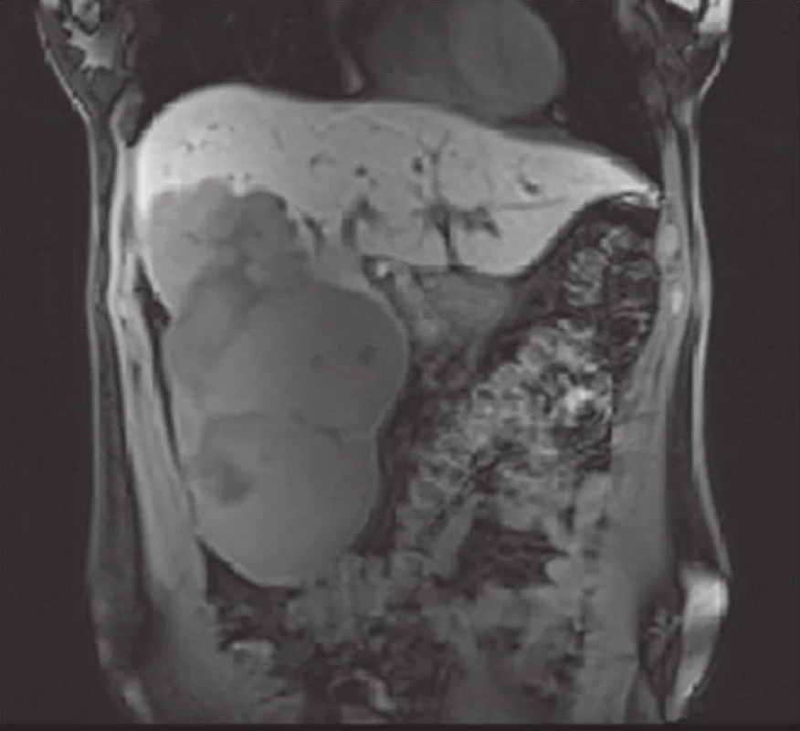 Magnetická rezonance jater – gigantický solitární hemangiom jater s průměrem 19,1 cm řešený enukleací
Fig. 1: Magnetic resonance imaging of the liver – solitary giant liver hemangioma (19.1 cm in diameter) managed using enucleation