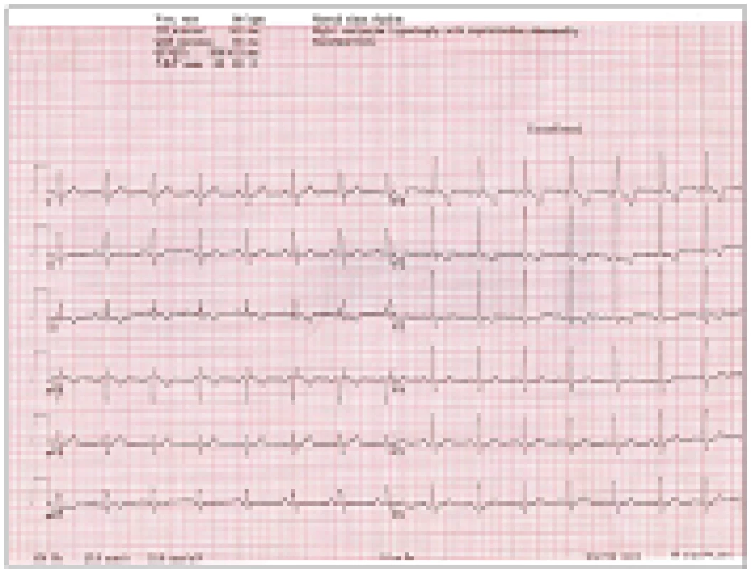 EKG: SR, fr. 80/min s výraznými známkami hypertrofie pravé komory.