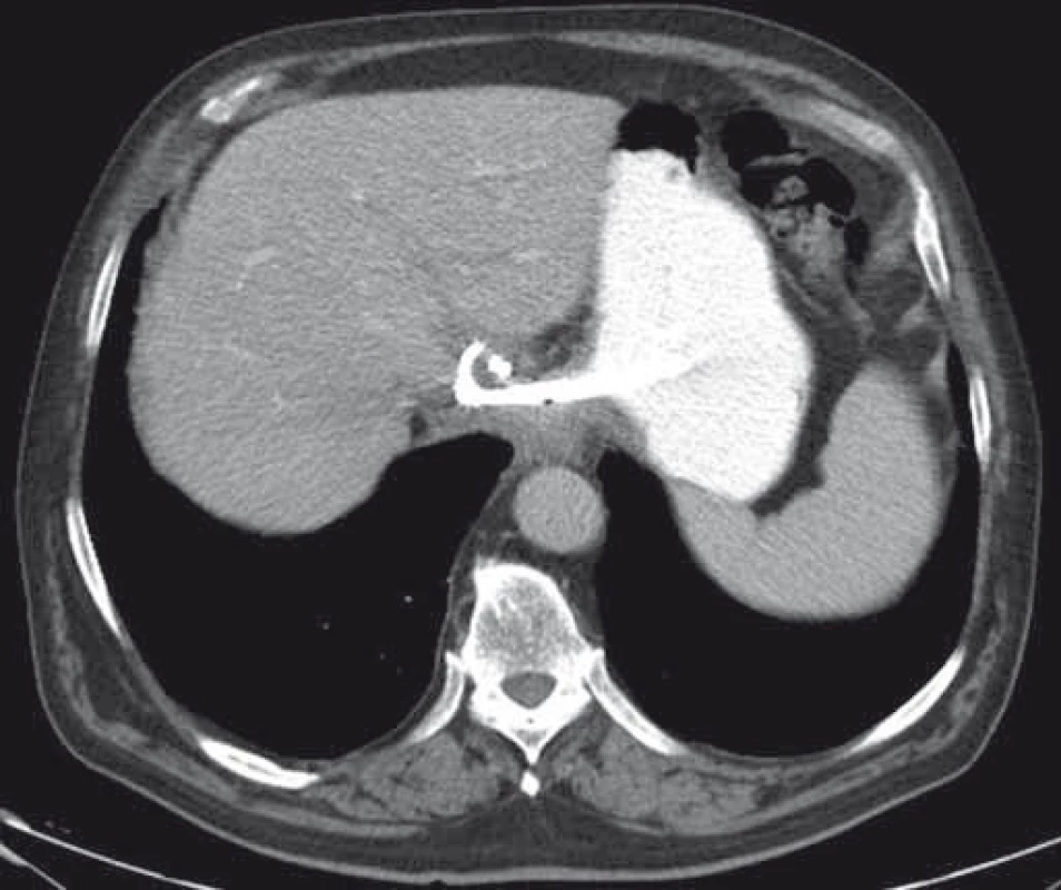 CT – úplná regresia abscesu dva mesiace po drenáži, double-pigtail stenty in situ.
Fig. 9. CT – complete resolution of an abscess two months after drainage, double-pigtail stents in situ.