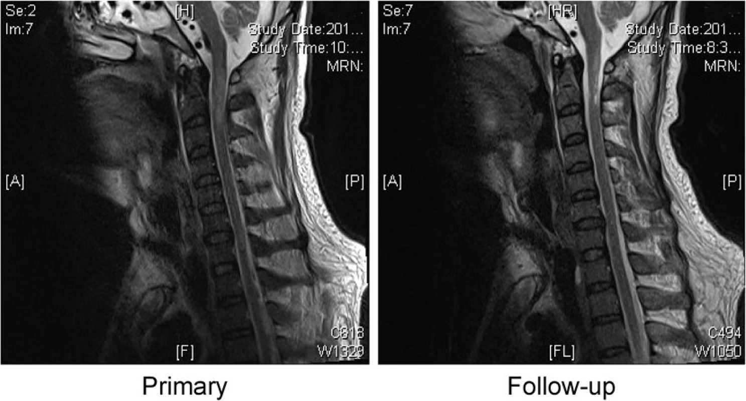A follow-up cervical MRI evaluation revealed a less extensive hyperintense region on sagittal sections of T2-weighted images