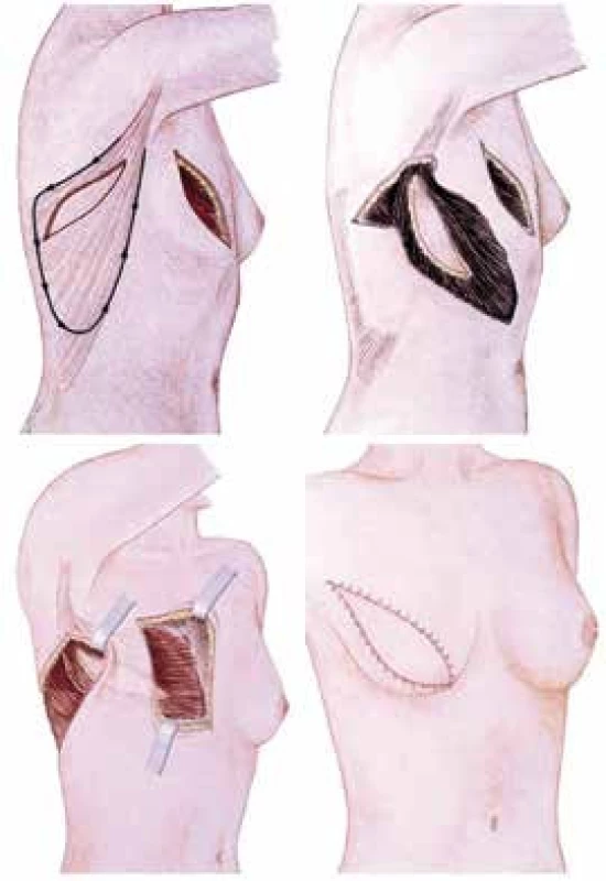 Schéma rekonstrukce prsu s užitím m. latissimus dorsi