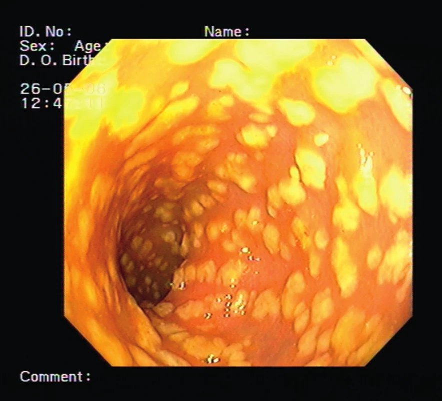 Endoskopický obraz nejtěžší formy infekce &lt;i&gt;Clostridium difficile&lt;/i&gt; – pseudomembranózní kolitida (ilustrativní snímek, archiv Oddělení endoskopických metod a sonografie Thomayerovy nemocnice)