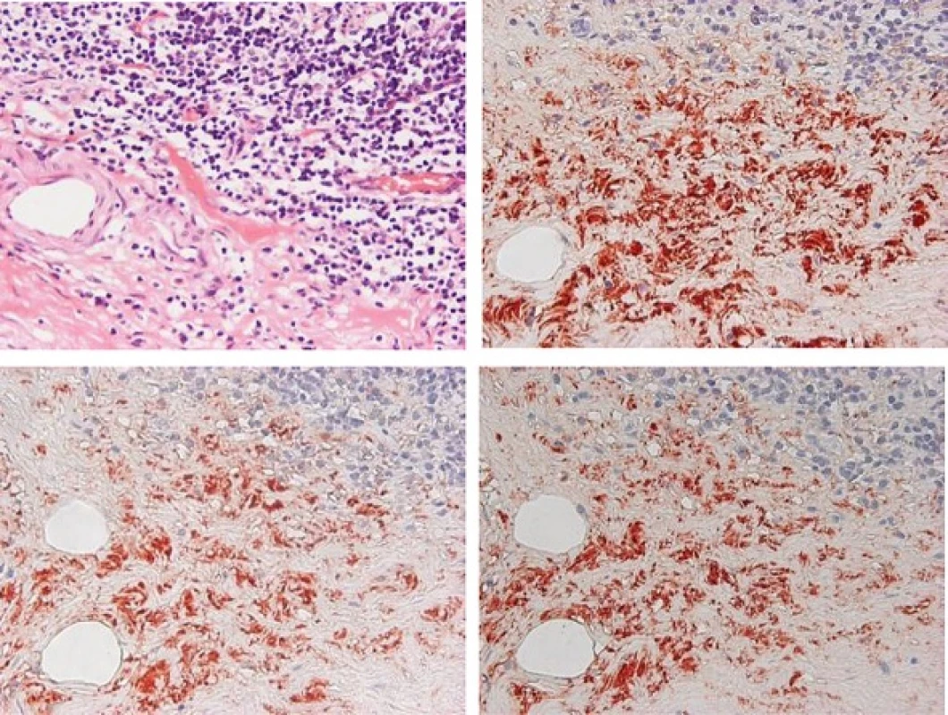 Immunohistological findings of the intestine tissues. Exacerbated intestine mucosal infiltration of lymphocytes and plasma cells with Hematoxylin-Eosin staining (a). Immunostaining of total IgA (b), IgA&lt;sub&gt;1&lt;/sub&gt; (c), IgA&lt;sub&gt;2&lt;/sub&gt; (d) in submucosal layer of intestine