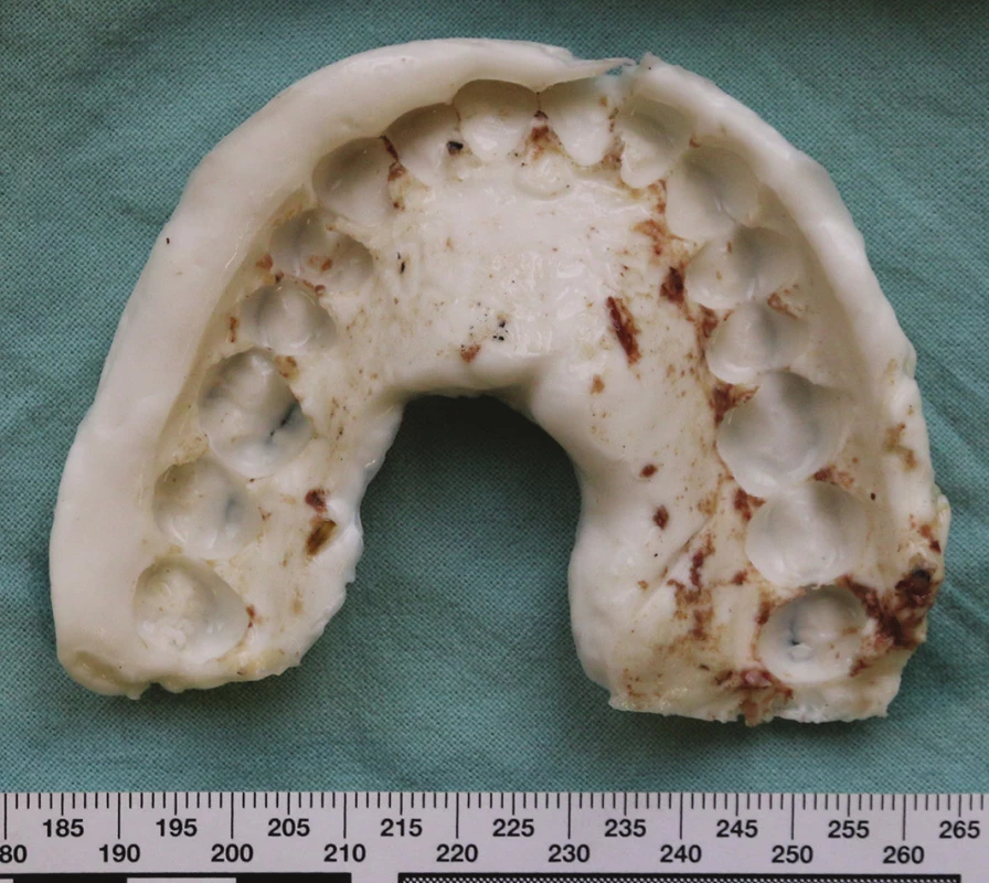 Otisk horního zubního oblouku zemřelé ženy