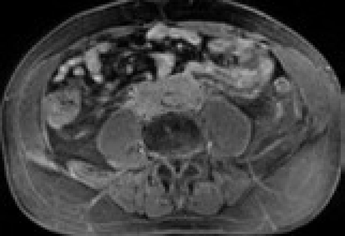 MRI – transverzální řez ve výši bifurkace aorty: rozsáhlý patologický infiltrát v retroperitoneu sahající od odstupu renálních tepen až do malé pánve přibližně 5 cm pod úroveň bifurkace aorty, do kterého jsou zavzaty velké cévy, zejména abdominální aorta a pravá společná ilická tepna. Komprese dolní duté žíly infiltrátem. Kraniokaudální rozměr infiltrátu je 14 cm. V transverzálním řezu v úrovni bifurkace aorty rozměr infiltrátu 74 × 38 mm.
