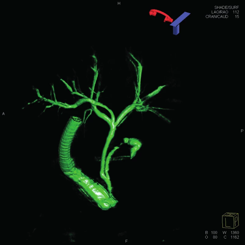 3D ERCP
Fig. 6: 3D ERCP