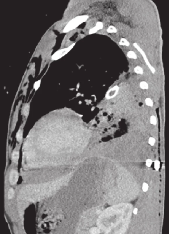 Lacerace dolního laloku levé plíce, fluidotorax, malý perikardiální výpotek − sagitální řez
Fig. 3: Lower left lobe laceration, fluidothorax, small pericardial effusion − sagittal section